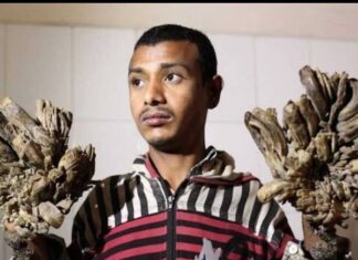 bangladesh-tree-man-abul-bajandar