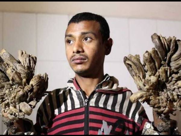 bangladesh-tree-man-abul-bajandar bangladesh-tree-man-abul-bajandar