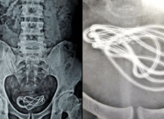 doctors-found-charging-cable-in-urinary-bladder